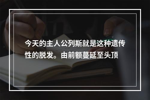 今天的主人公列斯就是这种遗传性的脱发。由前额蔓延至头顶