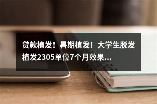 贷款植发！暑期植发！大学生脱发植发2305单位7个月效果图