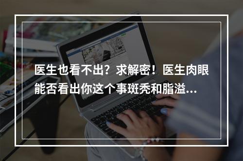 医生也看不出？求解密！医生肉眼能否看出你这个事斑秃和脂溢性脱发