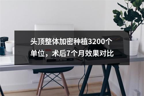 头顶整体加密种植3200个单位，术后7个月效果对比