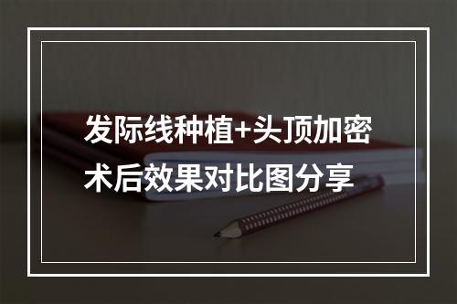 发际线种植+头顶加密术后效果对比图分享