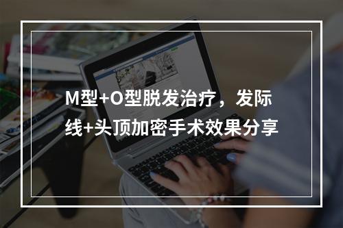 M型+O型脱发治疗，发际线+头顶加密手术效果分享