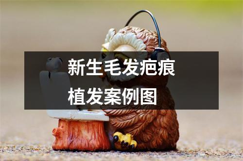 新生毛发疤痕植发案例图