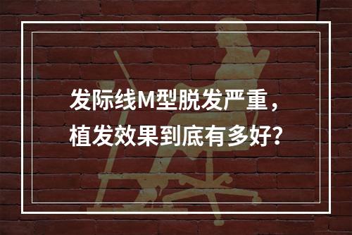 发际线M型脱发严重，植发效果到底有多好？