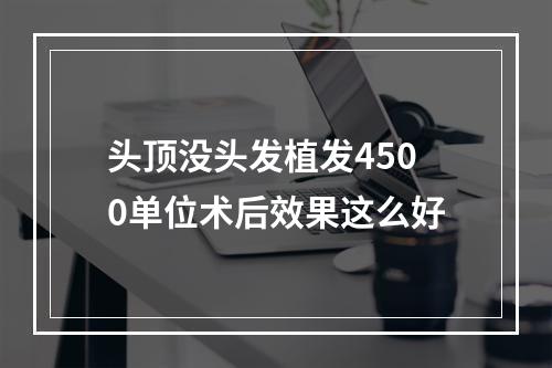 头顶没头发植发4500单位术后效果这么好