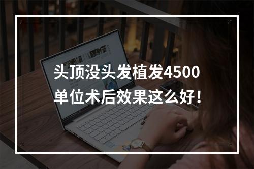 头顶没头发植发4500单位术后效果这么好！